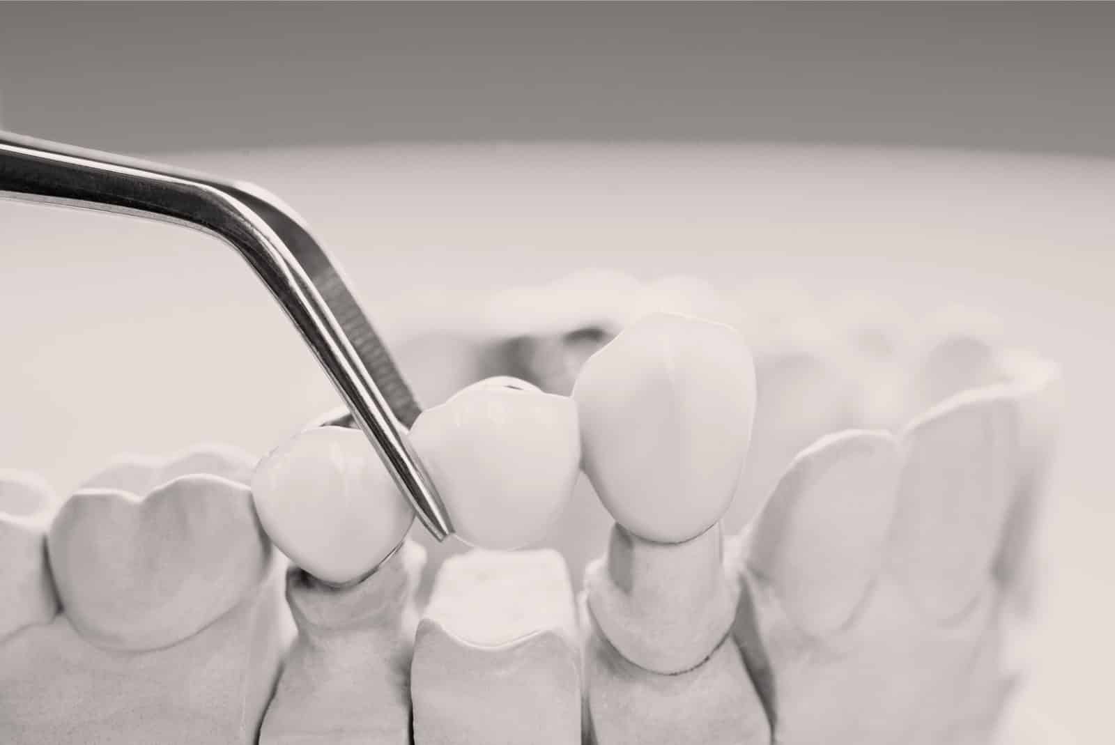 La pose des couronnes dentaires à Lyon - Dr Serge Sobol : Chirurgien-dentiste