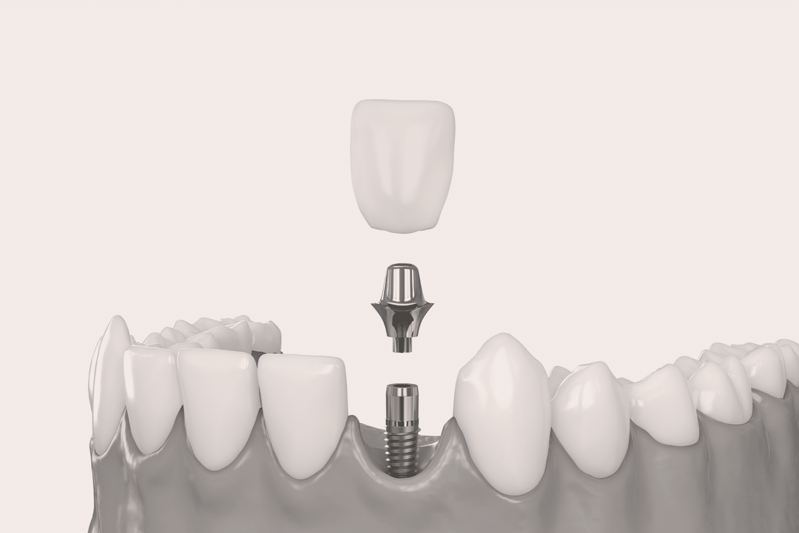 L’implantologie dentaire : remplacer des dents manquantes à Lyon