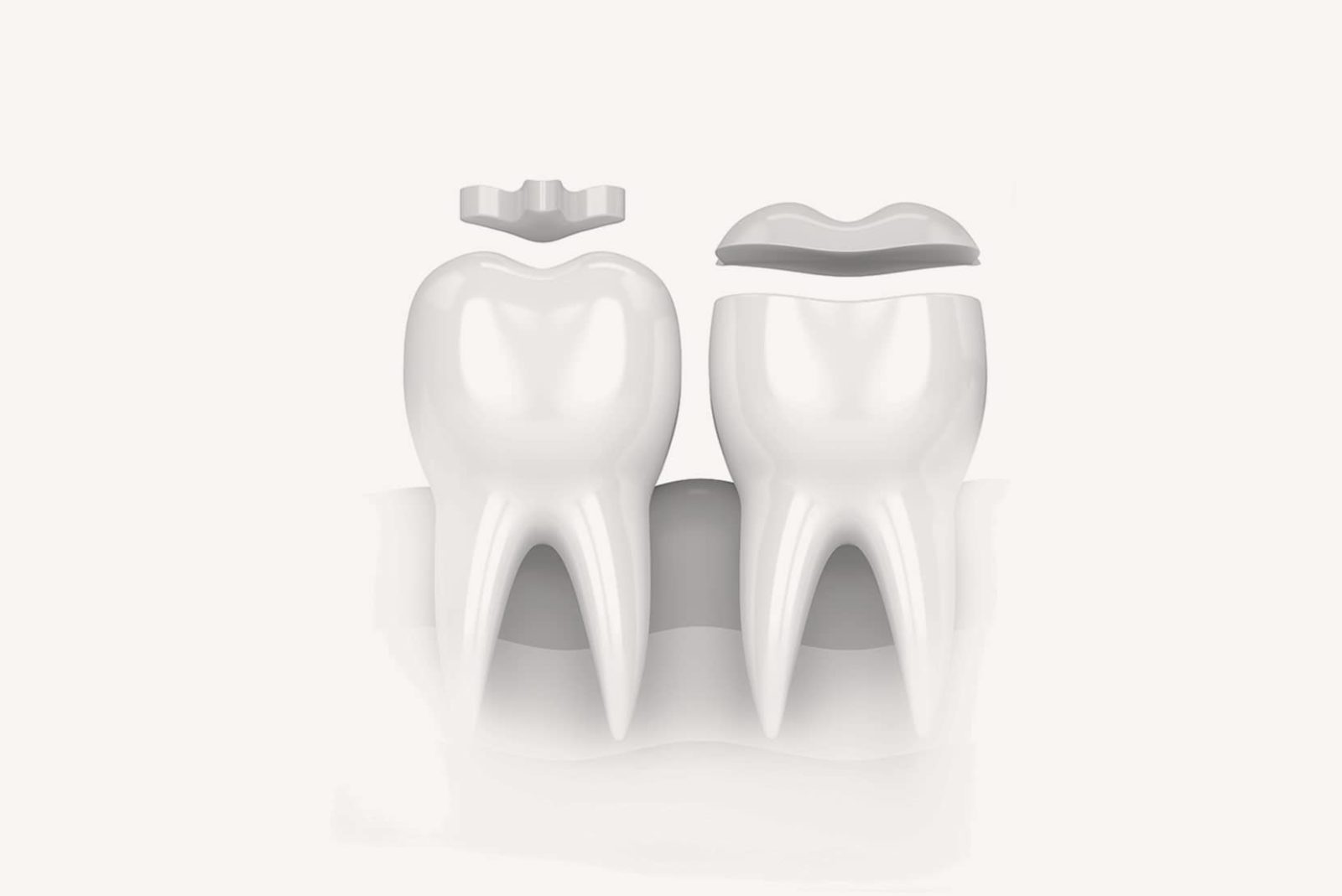 Inlays Onlays pour traiter vos problèmes dentaires à Lyon - Dr Serge Sobol