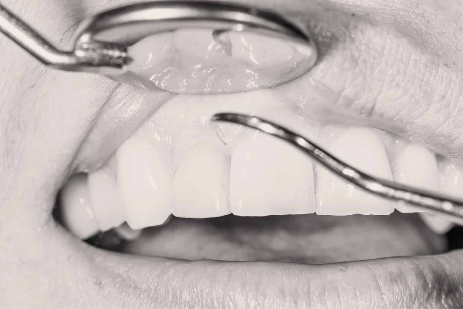 Traitement des mobilités dentaires à Lyon - Dr Serge Sobol