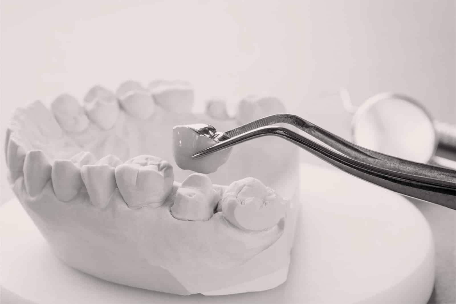 Les prothèses et autres traitements pour l’esthétique dentaire à Lyon