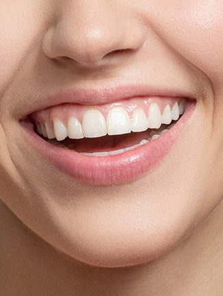 Esthétique du sourire à Lyon - Dr Serge Sobol : Chirurgien-dentiste