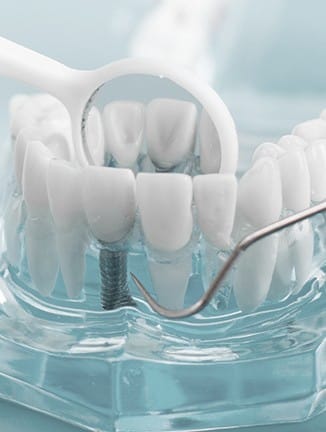 Implantologie dentaire à Lyon - Dr Serge Sobol : Chirurgien-dentiste