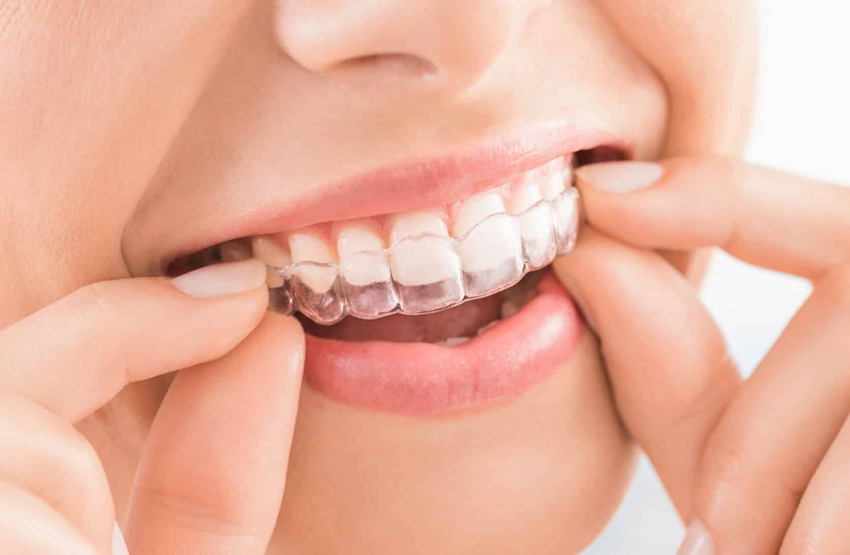 Peut-on faire un éclaircissement dentaire durant un traitement Invisalign ? | Dr Sorbol | Lyon l