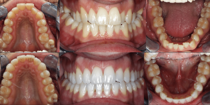 Traitement des dents invisalign, blanchiment dentaire | Dr Sobol | Lyon